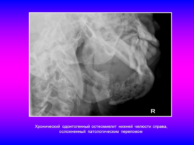 Хронический одонтогенный остеомиелит нижней челюсти справа,  осложненный патологическим переломом